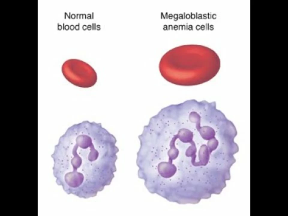 The Role of Folic Acid in the Management of Megaloblastic Anemia in Patients with Diabetes