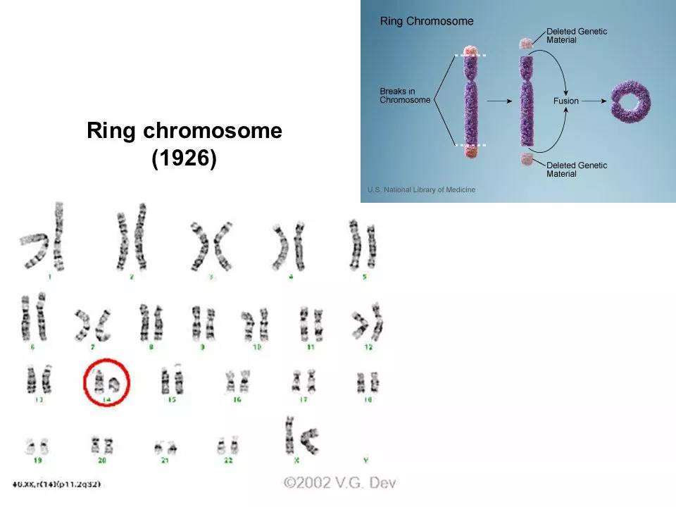 Understanding the Genetics of Chromosome-Positive Lymphoblastic Leukemia: A Guide for Patients